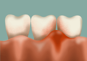 Periodontics Questions