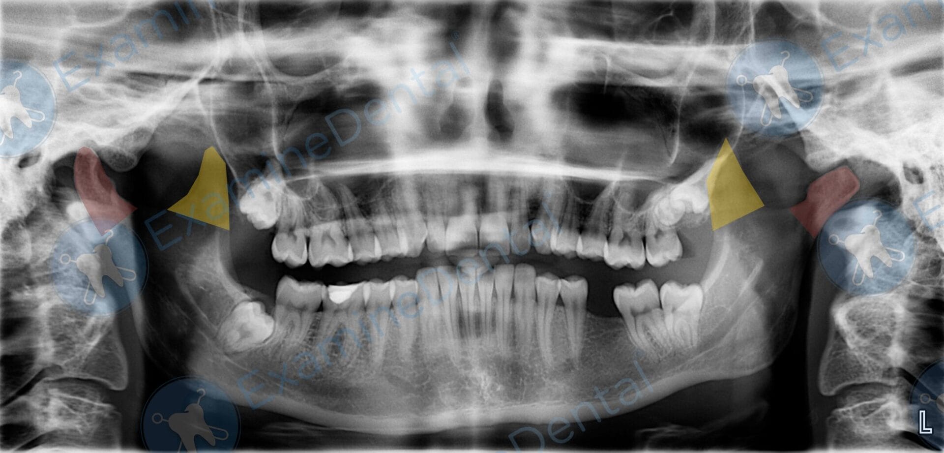 Anatomy of Panoramic Films - OPTs/DPTs/OPGs Condyle (brown) and coronoid process (yellow) highlighted on an OPT